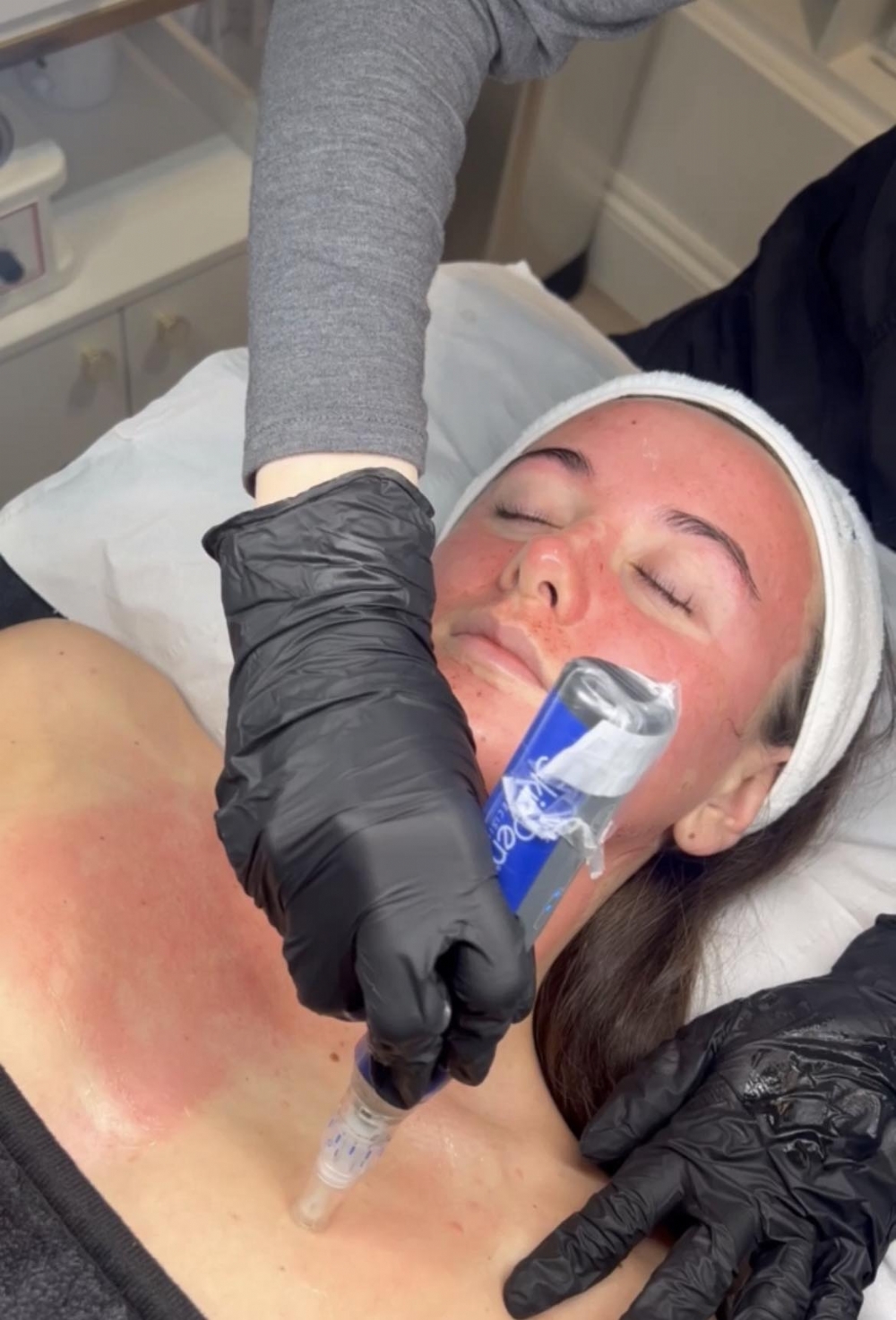 birthday skinpen 20 % off